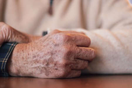 Das Alter zeichnet besondere Muster und Färbungen in die Haut – eine natürliche Folge der unregelmäßigeren Melanin-Verteilung in höheren Lebensjahren. Hand eines Seniors mit Pigmentflecken